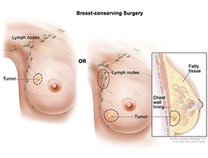 lumpectomy, mastectomy